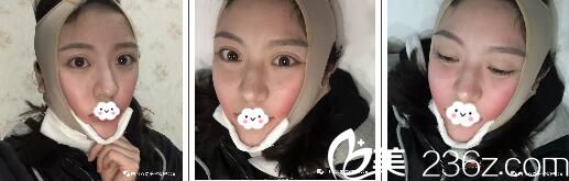 剛做完面部吸脂戴的頭套