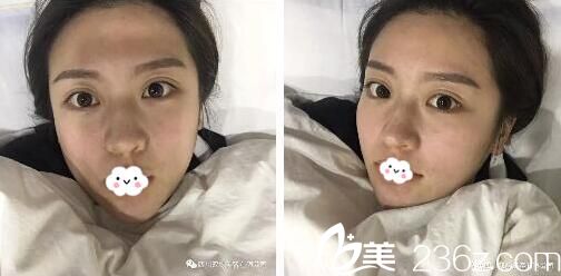 面部吸脂7天后效果