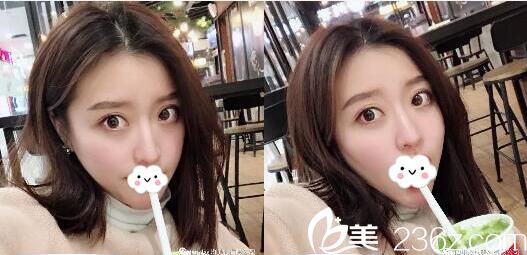 面部吸脂手術(shù)半個(gè)月恢復(fù)照片