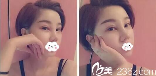 玻尿酸隆鼻術(shù)后11天效果