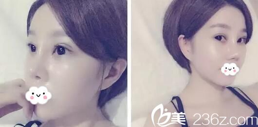 李隆才切開雙眼皮天恢復(fù)照片