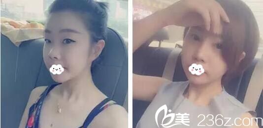 ?在四川達(dá)州雙均做的韓式雙眼皮和玻尿酸隆鼻，讓我美得混血！