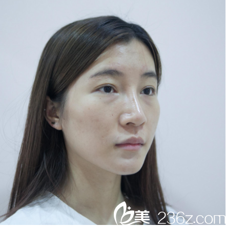 廣州美萊脂肪填充案例術前照片 廣州美萊脂肪填充案例術前照片