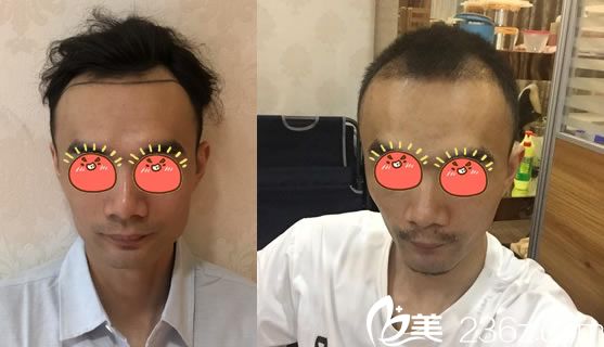 姚寶林給男士種植發(fā)際線案例