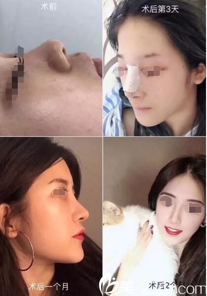 術(shù)前山根塌+朝天鼻在常州博仕做的假體隆鼻術(shù)前術(shù)后案例分享