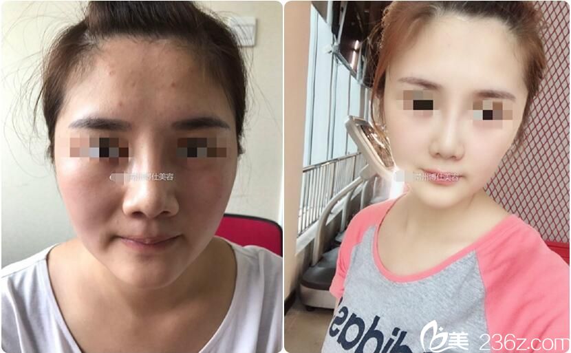 搜羅了好幾組常州博仕做的隆鼻和鼻綜合案例，來幫我分析一下這家醫(yī)院效果到底怎么樣