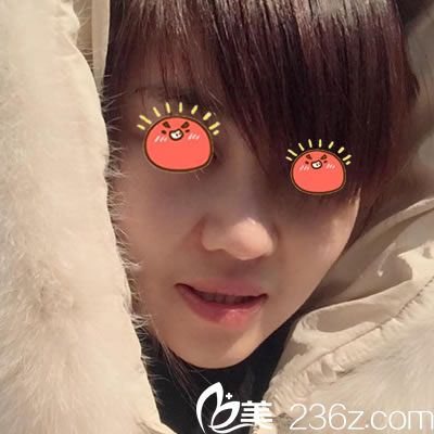 選擇寧波雅韓做隆鼻7天效果對(duì)比圖