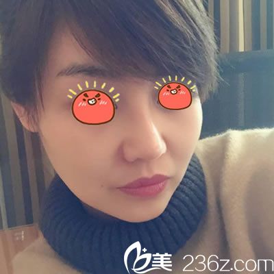 寧波雅韓龔濤隆鼻案例30天效果