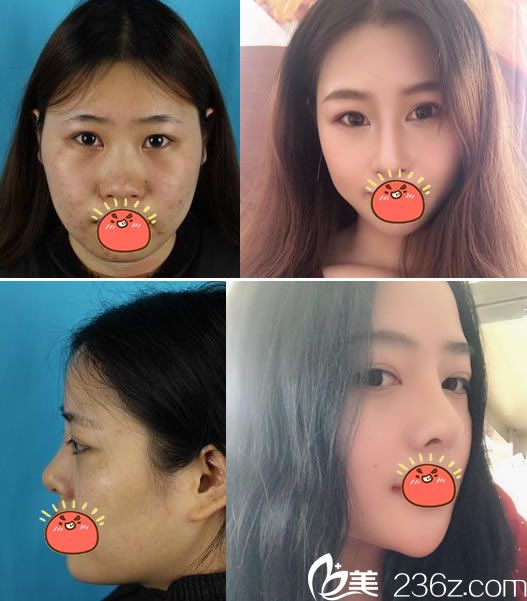 寧波雅韓龔濤院長(zhǎng)隆鼻案例