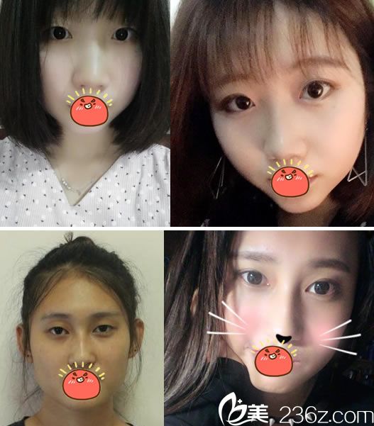 寧波雅韓劉成林院長(zhǎng)割雙眼皮案例