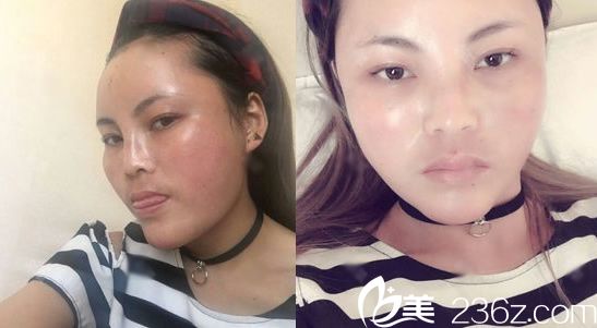 做完自體脂肪填充6天恢復(fù)照