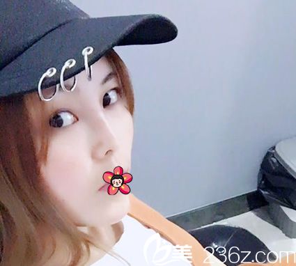 做完自體脂肪填充30天恢復(fù)照