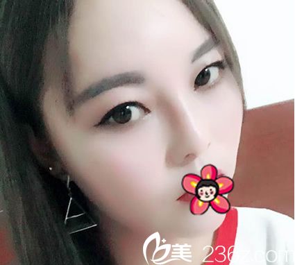 天生面部凹陷,與寧波雅韓劉成林院長溝通多次才確定做自體脂肪填充手術(shù),效果出來很不錯(cuò)喲