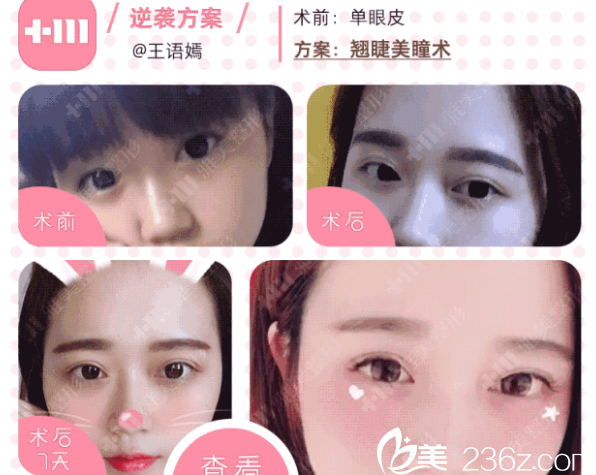 衡陽(yáng)雅美的翹睫美瞳術(shù)真人案例