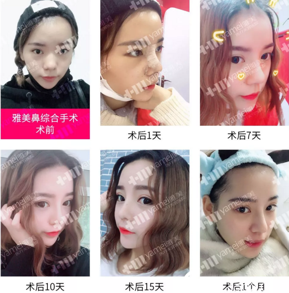 衡陽(yáng)雅美鼻綜合真人案例