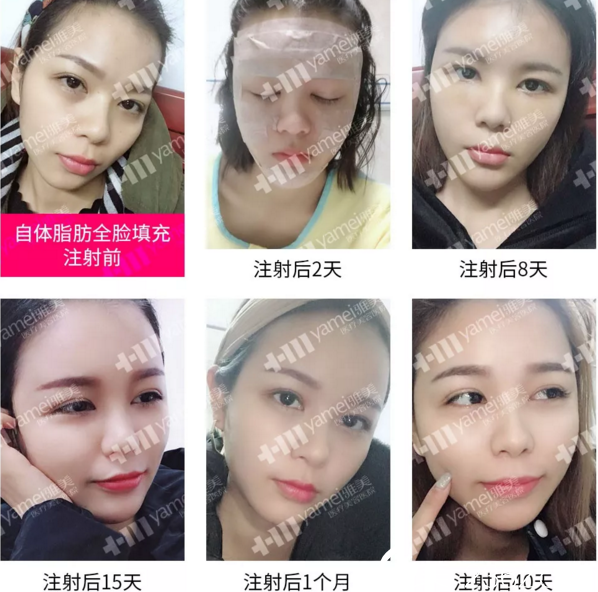 衡陽(yáng)雅美自體脂肪全臉填充注射真人案例