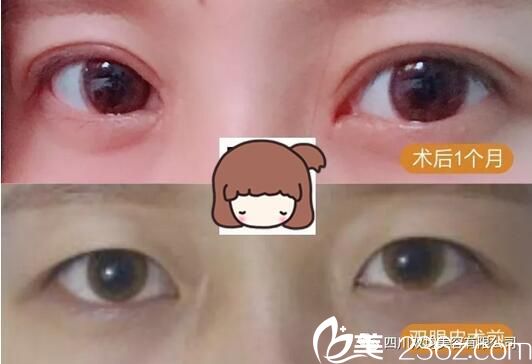 達(dá)州雙均雙眼皮+開眼角術(shù)后一個(gè)月對(duì)比