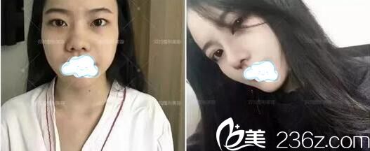 達(dá)州雙開鼻綜合術(shù)前術(shù)后對(duì)比