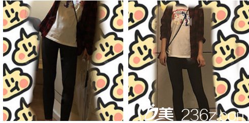 廣州韓妃于洪瑞大腿吸脂術后15天