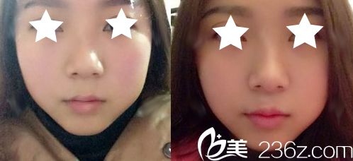 我在南寧華美整形打瘦臉前的照片 我在南寧華美整形打瘦臉前的照片