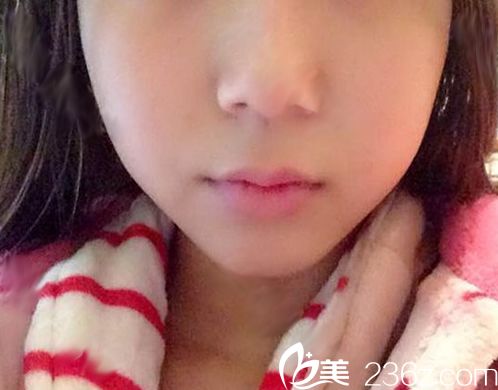 我在南寧華美打瘦臉 我在南寧華美打瘦臉