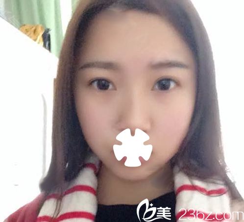 我在華美整形打瘦臉術(shù)后第10天照片 我在華美整形打瘦臉術(shù)后第10天照片