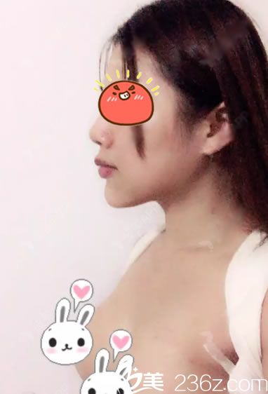 做完曼托假體隆胸5天恢復(fù)照