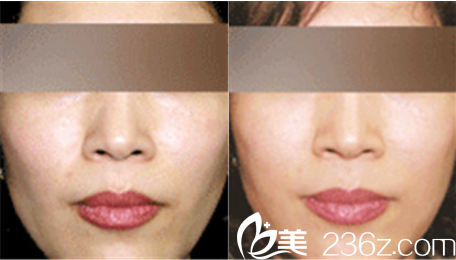 狎鷗亭MK整形外科自體脂肪面部填充真人案例