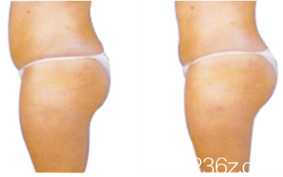 狎鷗亭MK整形外<!--<i data=20240703-sp></i>-->腿吸脂真人案例