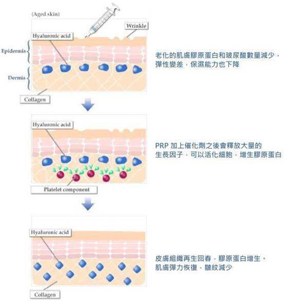 無(wú)錫施爾美分享自體脂肪填充除皺原理 無(wú)錫施爾美分享自體脂肪填充除皺原理