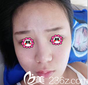 在北京藝星做假體隆鼻+耳軟骨墊鼻尖前樣子 在北京藝星做假體隆鼻+耳軟骨墊鼻尖前樣子