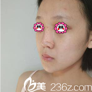 連凱峰醫(yī)生給我做假體隆鼻+耳軟骨墊鼻尖第3天樣子 連凱峰醫(yī)生給我做假體隆鼻+耳軟骨墊鼻尖第3天樣子