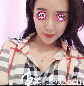 在北京藝星做假體隆鼻+耳軟骨墊鼻尖第15天效果 在北京藝星做假體隆鼻+耳軟骨墊鼻尖第15天效果