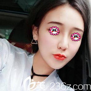 北京藝星連凱峰假體隆鼻+耳軟骨墊鼻尖案例 北京藝星連凱峰假體隆鼻+耳軟骨墊鼻尖案例