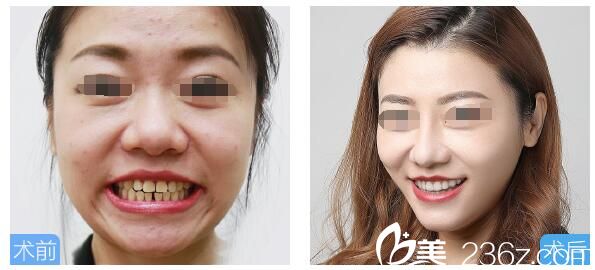 邱醫(yī)生牙齒矯正案例