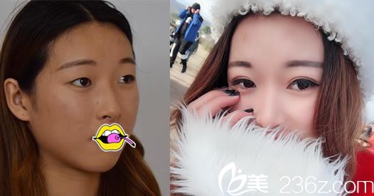 嘉興禾美傘光割雙眼皮案例 嘉興禾美傘光割雙眼皮案例