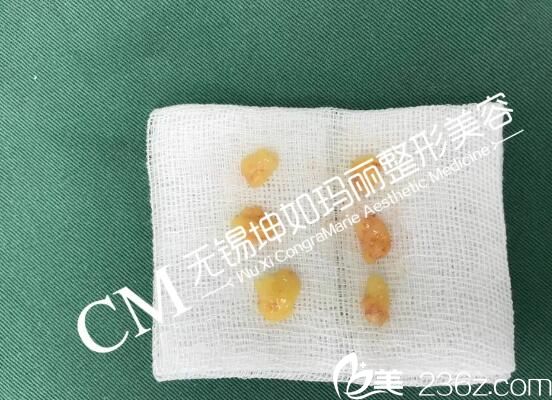 無痕祛眼袋所取出來的脂肪細(xì)胞