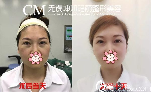 無錫坤如瑪麗真人案例直觀解答無痕祛眼袋效果怎么樣?遺傳性眼袋術后10天就消失