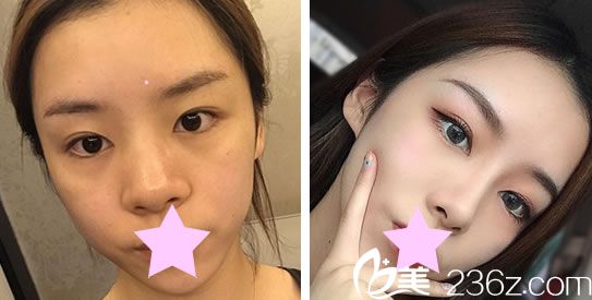 圣宜美容鼻綜合+肋軟骨隆鼻效果對(duì)比圖