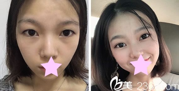 臺(tái)北圣宜眼綜合+全切雙眼皮效果對(duì)比圖