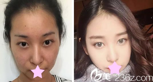 臺(tái)北圣宜美容整形面部線雕提升真人案例