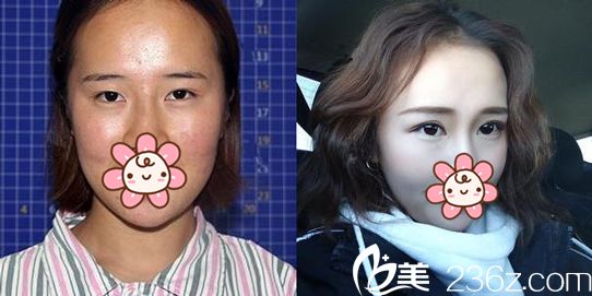 杜萬(wàn)文醫(yī)生做雙眼皮手術(shù)后對(duì)比照