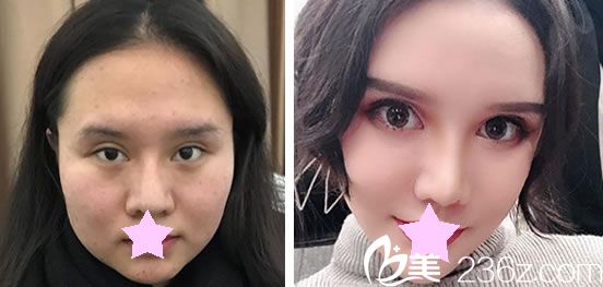 盧榮祥做假體隆鼻+下頜角整形效果對比圖