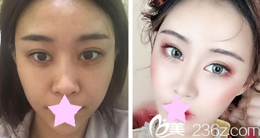 盧榮祥做面部脂肪填充效果對比圖