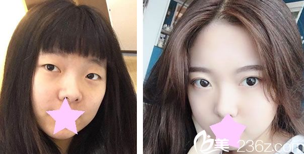 臺北楷鈞時尚美容診所盧榮祥做全切雙眼皮效果對比圖