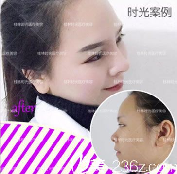 桂林時(shí)光美萊整形鼻綜合隆鼻案例