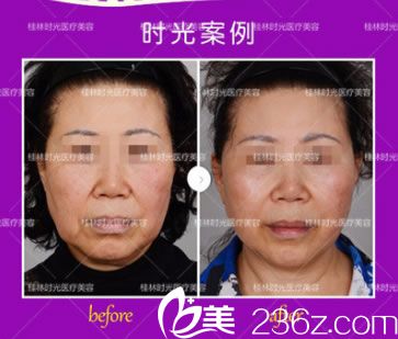 時(shí)光整形全臉4D線雕提升前后對比圖