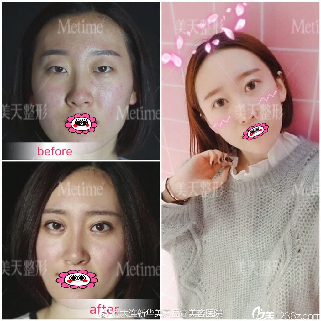 大連新華張井忠雙眼皮效果圖