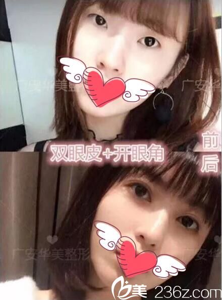 雙眼皮開眼角手術(shù)對比效果 雙眼皮開眼角手術(shù)對比效果