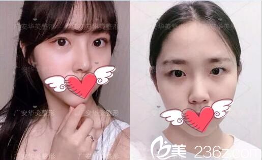 分享三例華美悅美整形美容醫(yī)院雙眼皮開(kāi)眼角整形手術(shù)案例